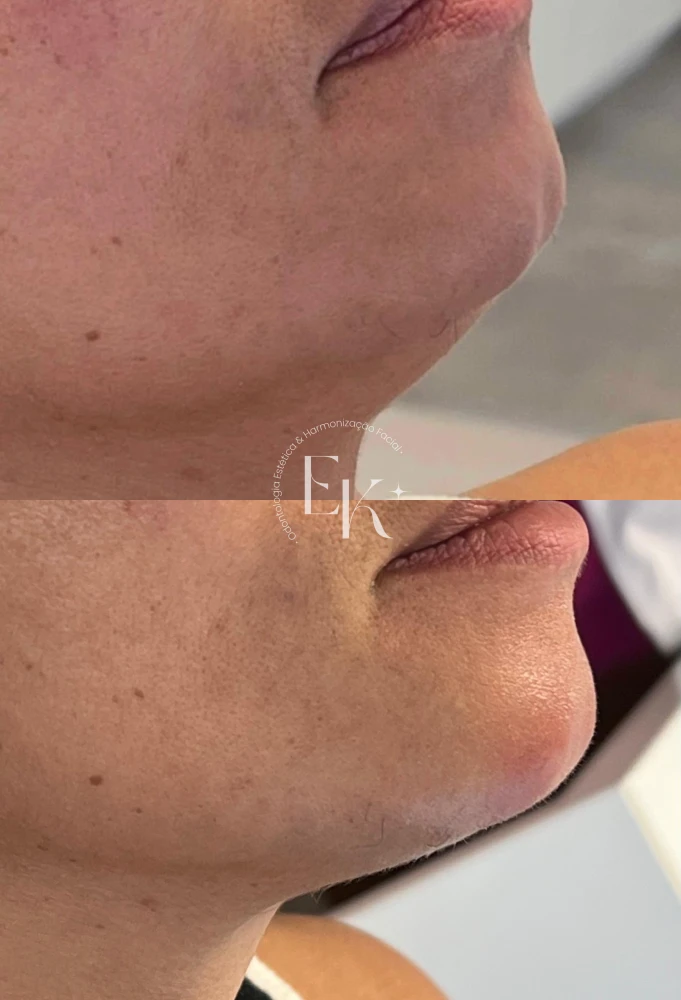 procedimento-elen-preenchimento-facial-1